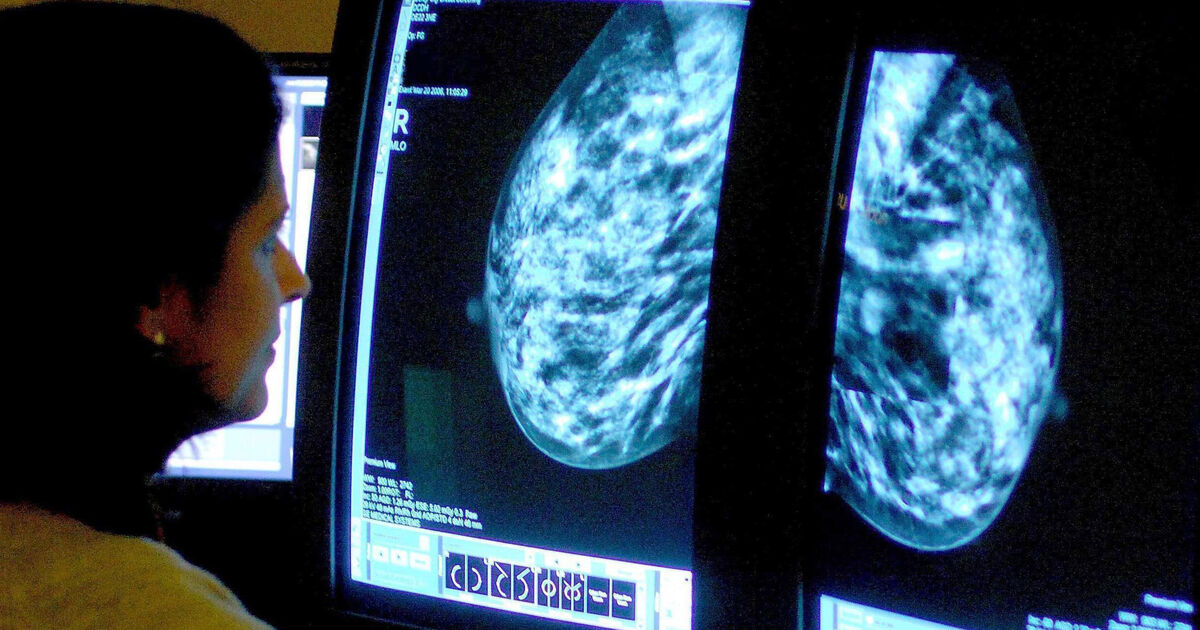 AI can pick up heart disease signs in breast cancer screenings